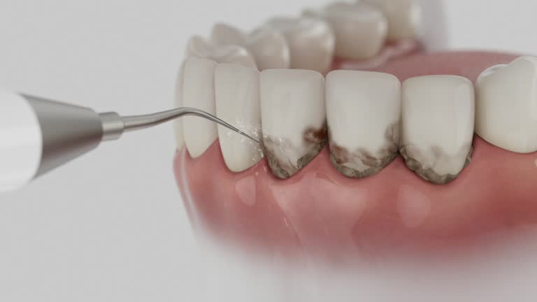 Trusted Wisdom Tooth Removal service in Hampshire, IL - Dentist Open Now